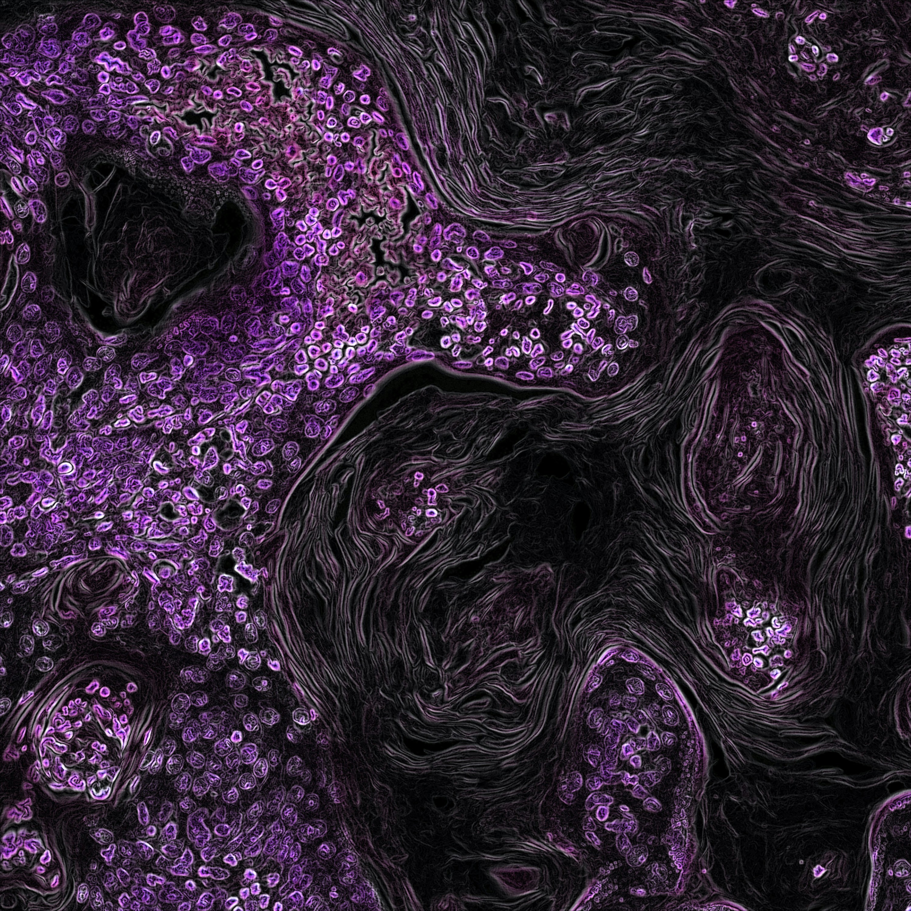 Stained tumour tissue section showing immune cells at the tumour margin